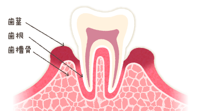 歯周病中期
