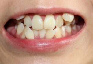 歯並びが悪いとどうなる？原因・影響・治療方法までわかりやすく解説